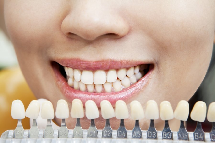 Dantų balinimas – norintiems dar gražesnės šypsenos